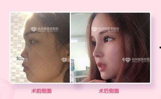 杭州整容爆料案件最新情况,真相逐步浮出水面 第3张 杭州整容爆料案件最新情况,真相逐步浮出水面 第3张